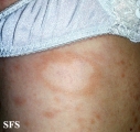 leprosy borderline