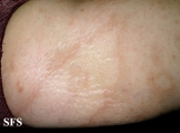 leprosy borderline