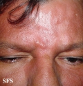 leprosy borderline