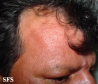 leprosy borderline