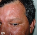 leprosy borderline