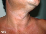 leprosy borderline
