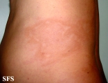 leprosy borderline