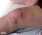 leprosy borderline