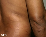 leprosy borderline