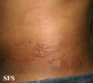 leprosy borderline