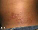 leprosy borderline