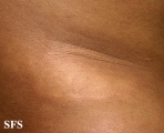 leprosy borderline
