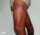 leprosy borderline