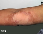 leprosy borderline