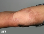 leprosy borderline