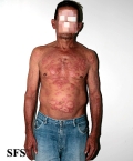 leprosy borderline