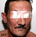 leprosy borderline