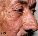 leprosy borderline