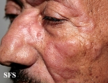 leprosy borderline