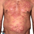 leprosy borderline