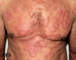 leprosy borderline