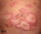 leprosy borderline