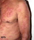 leprosy borderline