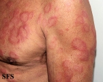 leprosy borderline