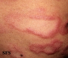 leprosy borderline