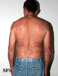 leprosy borderline