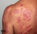 leprosy borderline