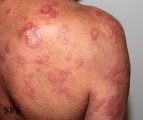 leprosy borderline