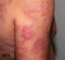 leprosy borderline