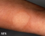 leprosy borderline
