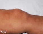 leprosy borderline