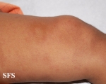 leprosy borderline