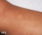 leprosy borderline