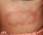 leprosy borderline