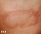 leprosy borderline