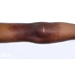 lichen aureus