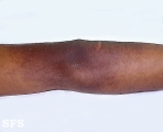 lichen aureus