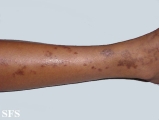 lichen aureus