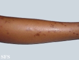 lichen aureus