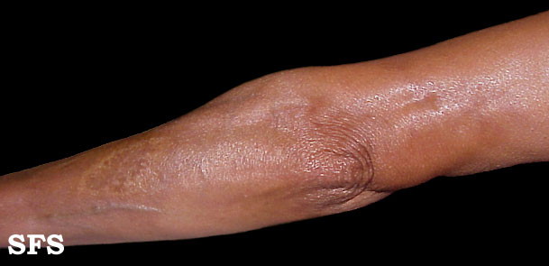 Linear Scleroderma Arm