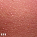 miliaria