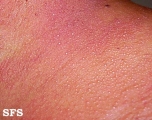 miliaria
