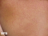 miliaria