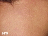 miliaria