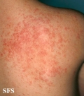 miliaria
