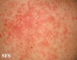 miliaria