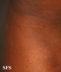 miliaria
