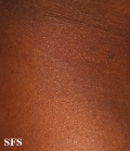 miliaria