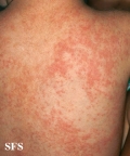 miliaria