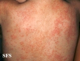 miliaria
